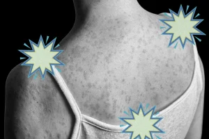 Measles Immune Amnesia: The Hidden Long‑Term Threat Reviving Global Health Fears