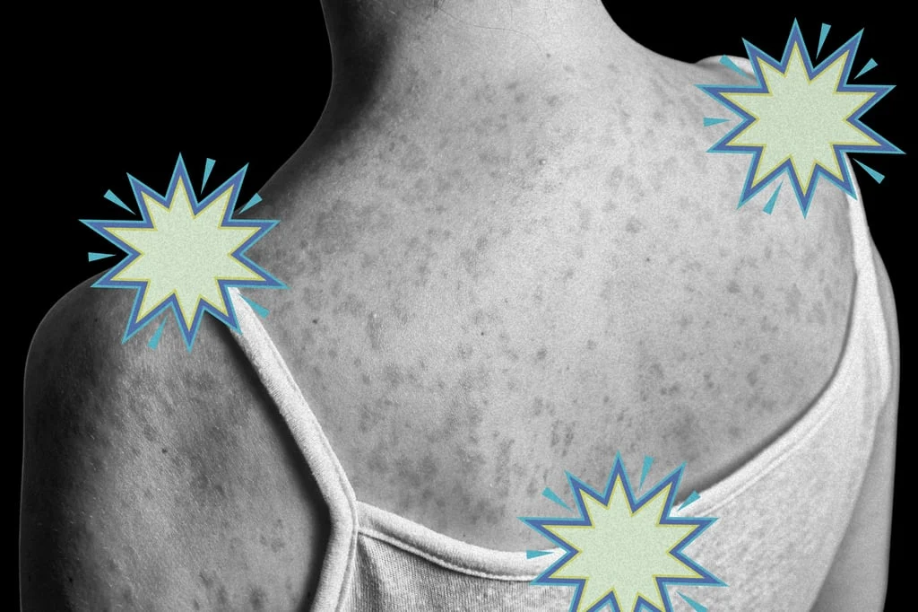 Measles Immune Amnesia: The Hidden Long‑Term Threat Reviving Global Health Fears