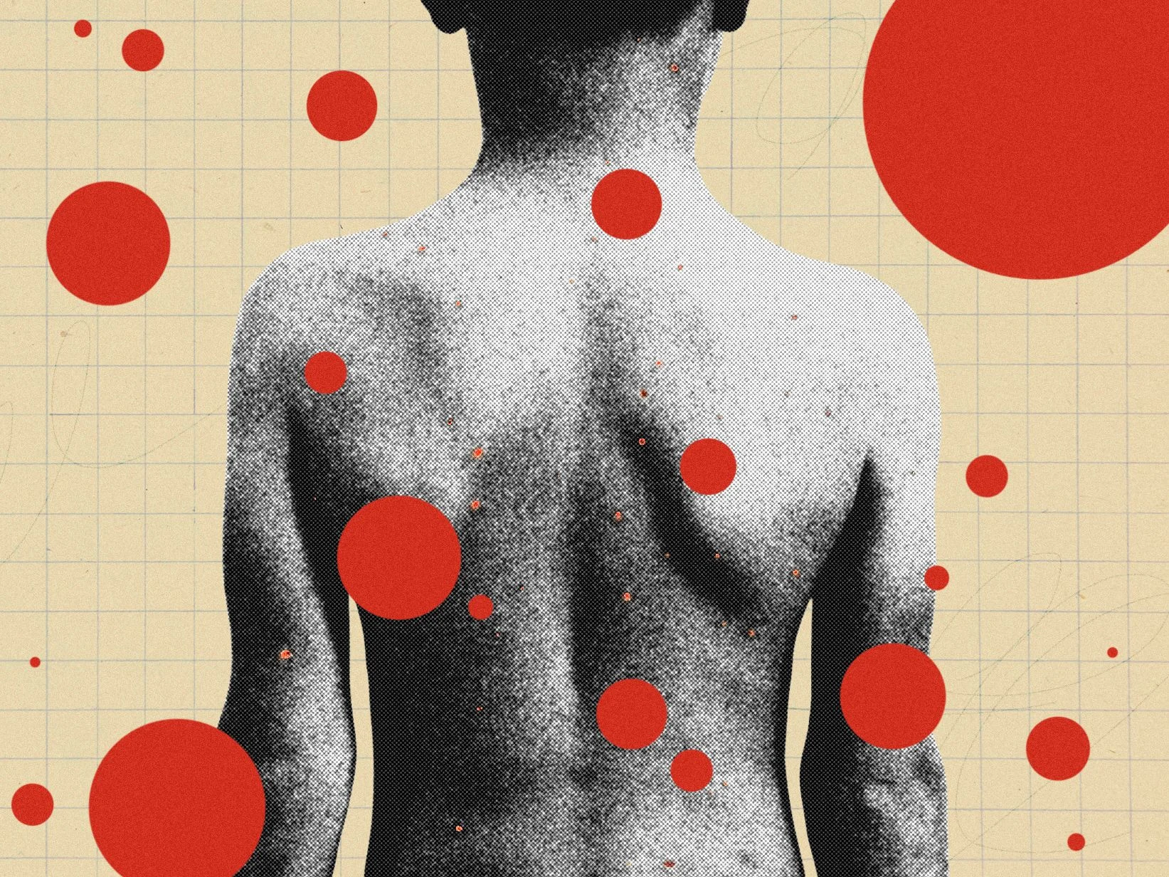 Why Chickenpox Parties Remain a Misguided Immunity Myth