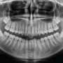 Biodegradable Nanobone: A Game‑Changer for Bone Regrowth Without Grafts